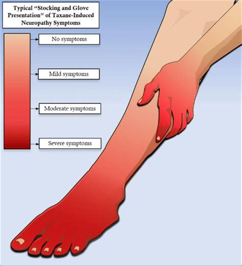 stocking glove syndrome|Glove and Stocking Pain: Sign of Peripheral Neuropathy